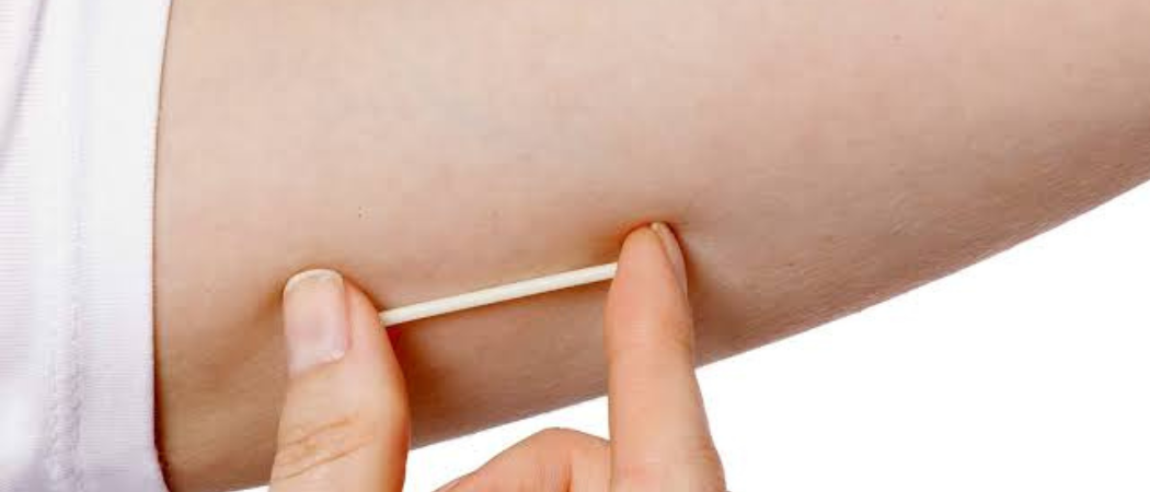 Métodos Anticonceptivos